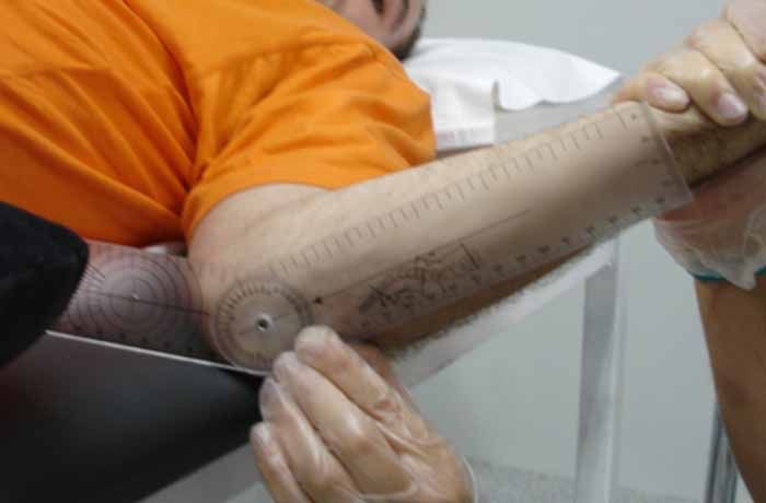 Centro de rehabilitación daño cerebral adquirido toxina butolínica