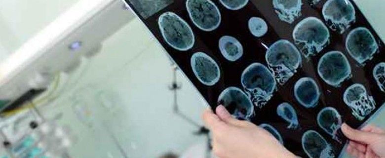 Neurorrehabilitación en UCI